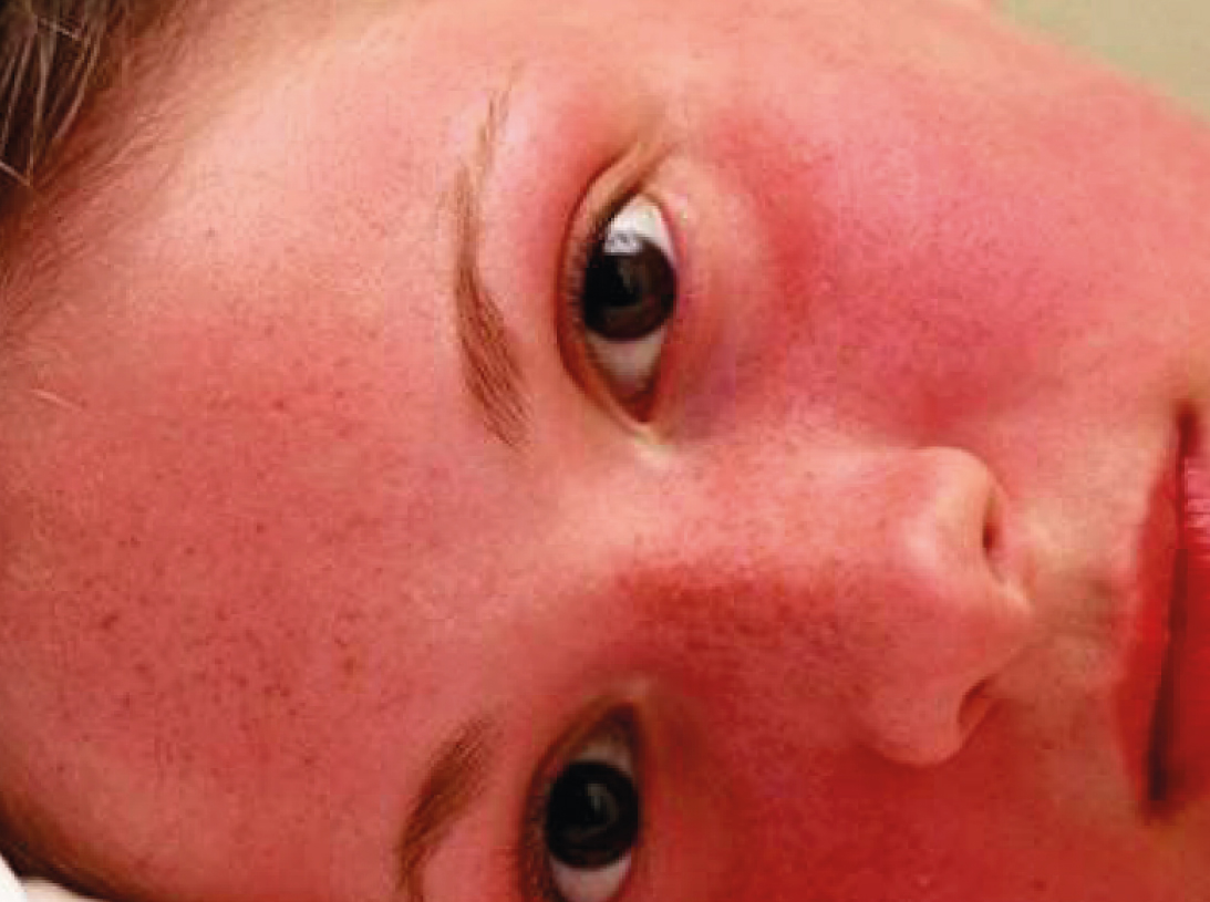 Пигментные пятна на коже лица от солнца – как избавиться и убрать пигментацию
